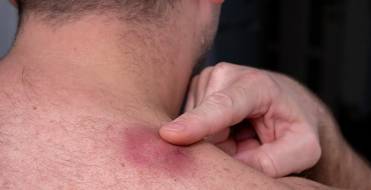 What Happens During Cyst Surgery and Recovery?