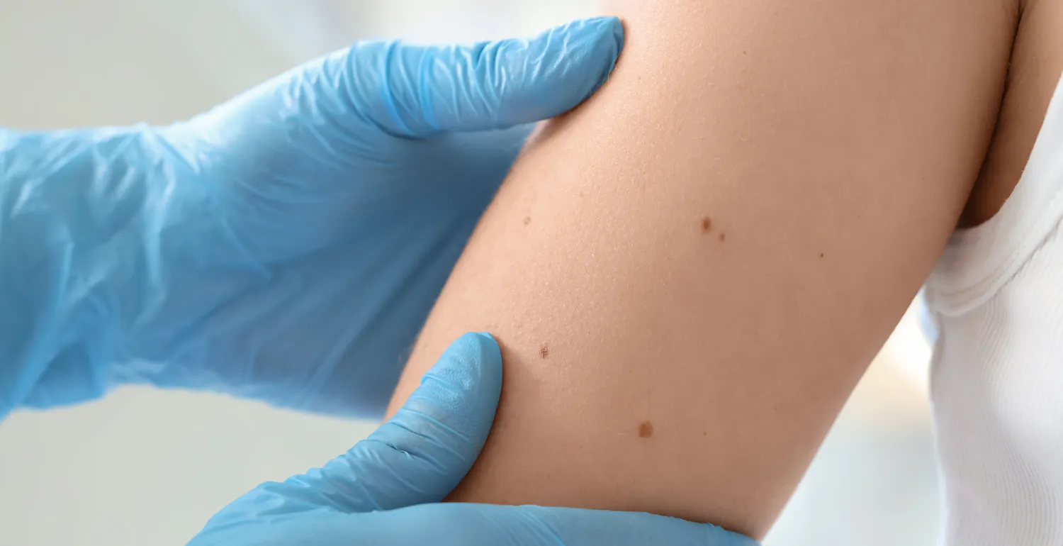 Skin specialist examining moles