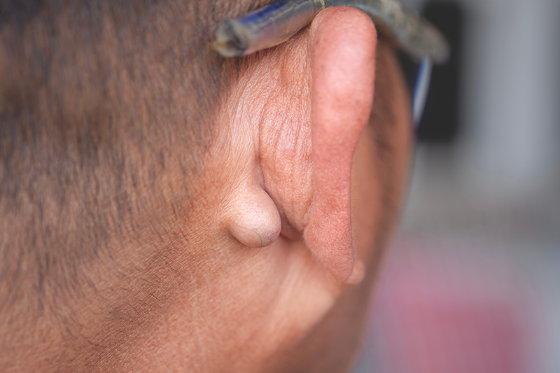 A sebaceous cyst behind a patient’s ear