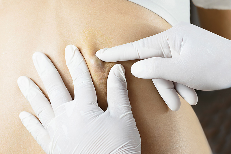 A dermatologist examining a patient’s sebaceous cyst.