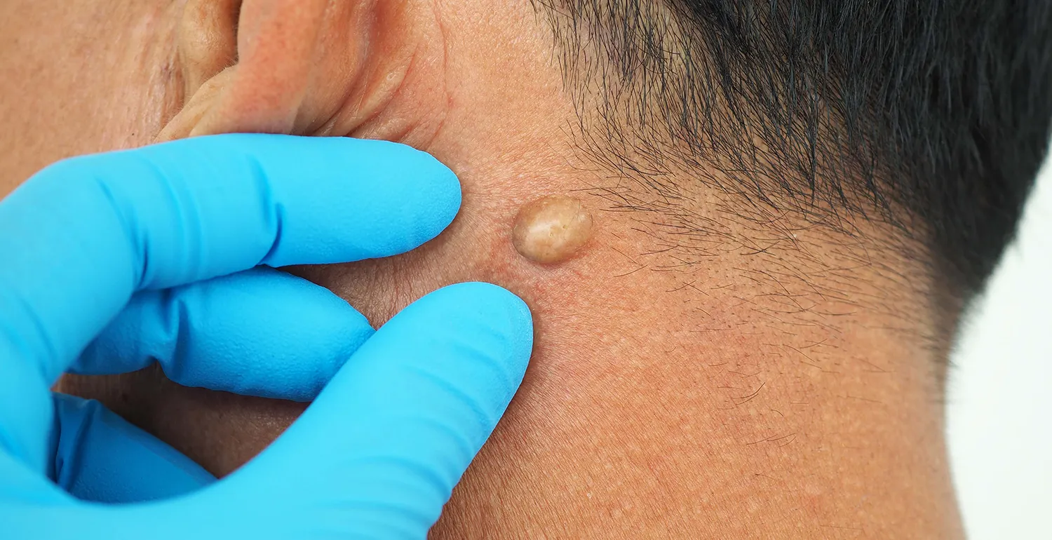 Sebaceous Cyst vs Lipoma: How Can You Tell the Difference?