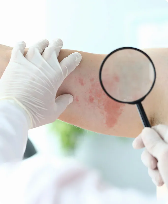 How Are Hives Treated at TSN Dermatology?