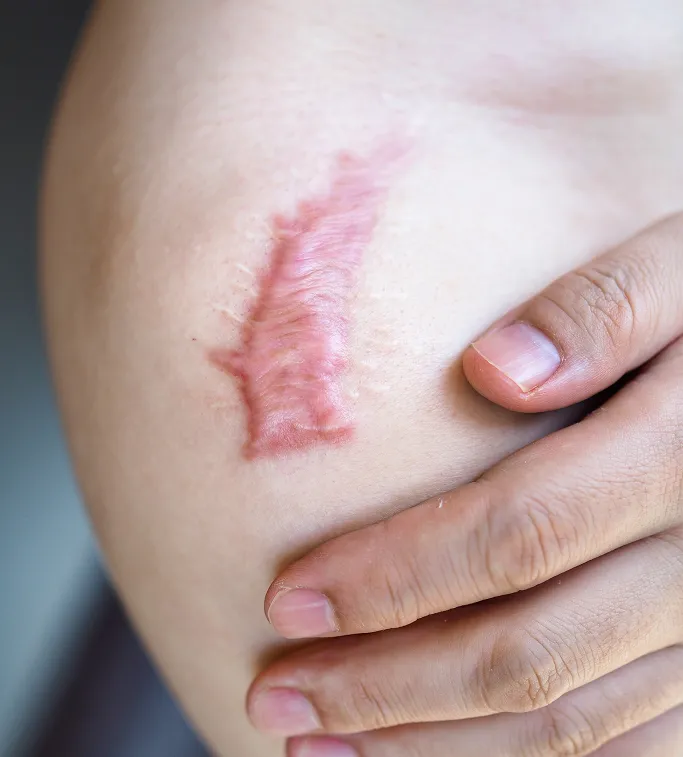 How Are Keloid Scars Treated at TSN Dermatology?