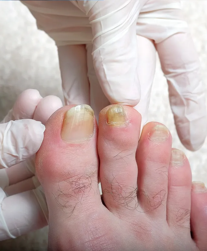 How Are Nail Conditions Treated at TSN Dermatology?