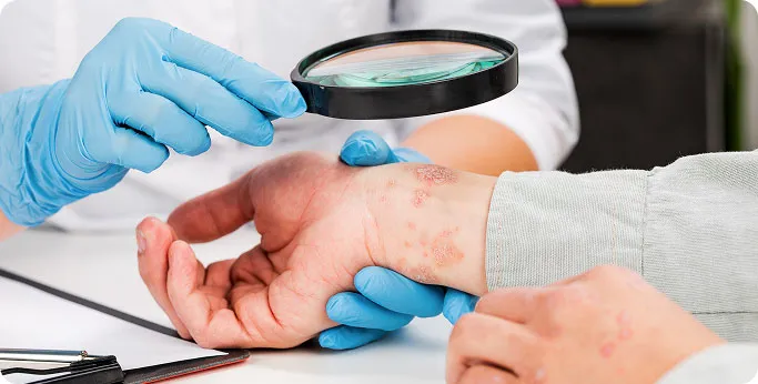 How Is Psoriasis Treated at TSN Dermatology?