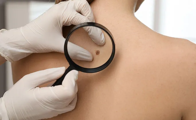 How Are Skin Cancers Screened at TSN Dermatology?