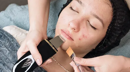 Acne Scar Treatment