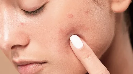 Acne Treatment