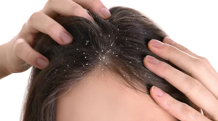 Dandruff Treatment