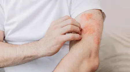 Eczema Treatment