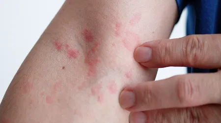 Hives (Urticaria) Treatment