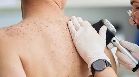Skin Cancer Surgery