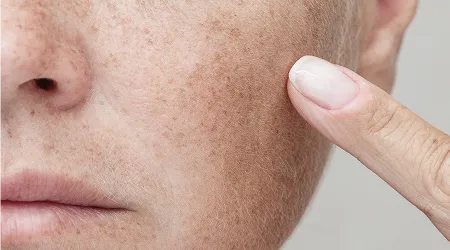 Skin Pigmentation