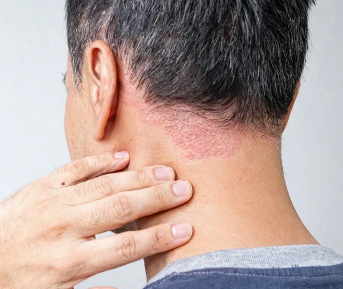 When Should You See a Dermatologist for Dandruff?