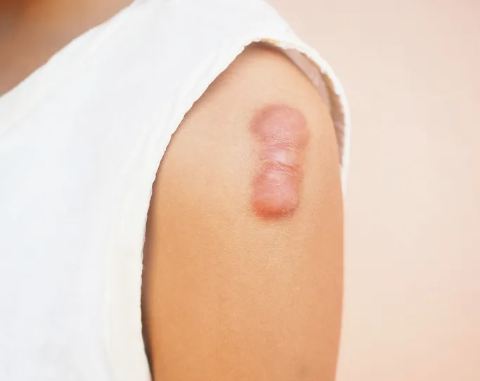 When Should You See a Dermatologist for Keloid Scars?