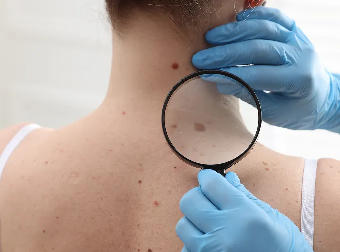 When Should You See a Dermatologist for a Mole?