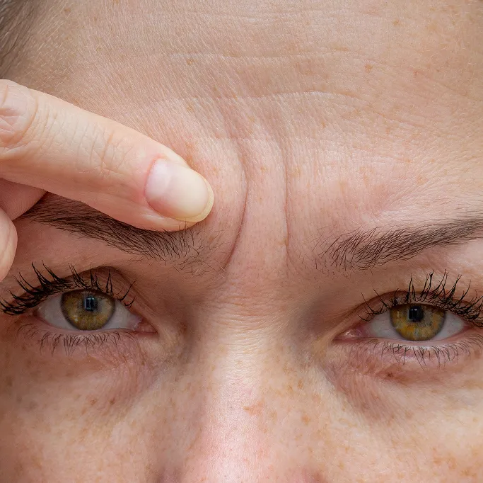When Should You See a Dermatologist for Wrinkles?