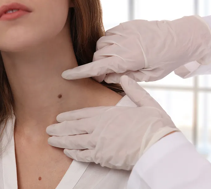 Common Symptoms of Benign Skin Growth to Look Out For