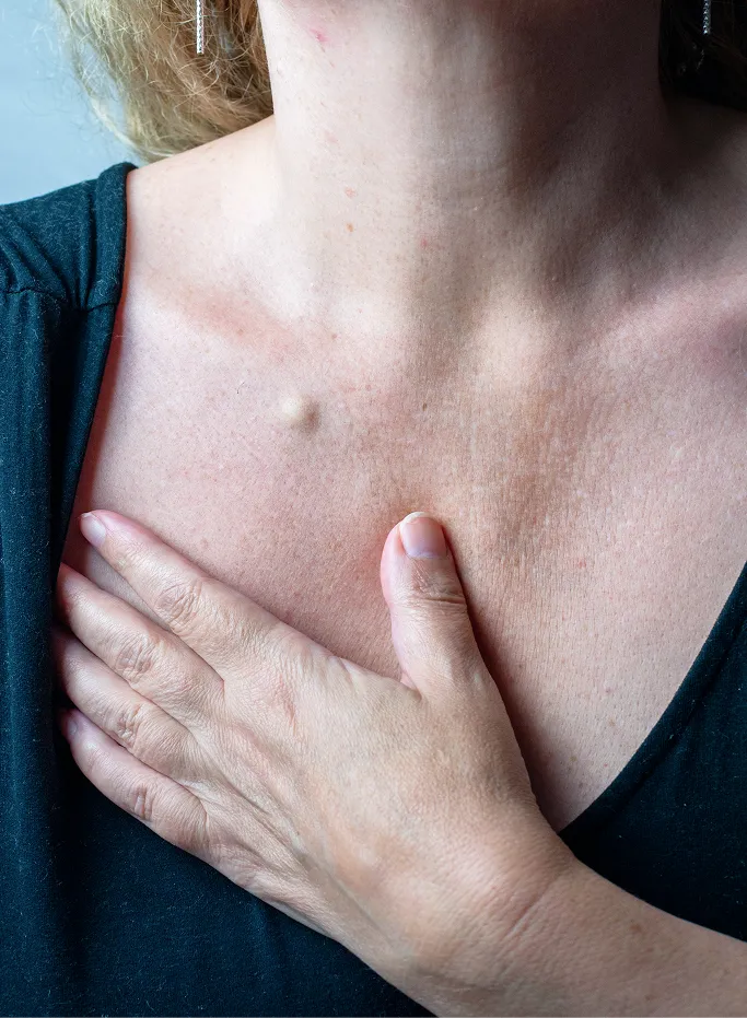 Common Symptoms of Cysts to Look Out For