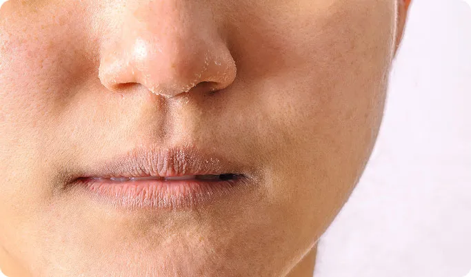 Common Symptoms of Eczema to Look Out For
