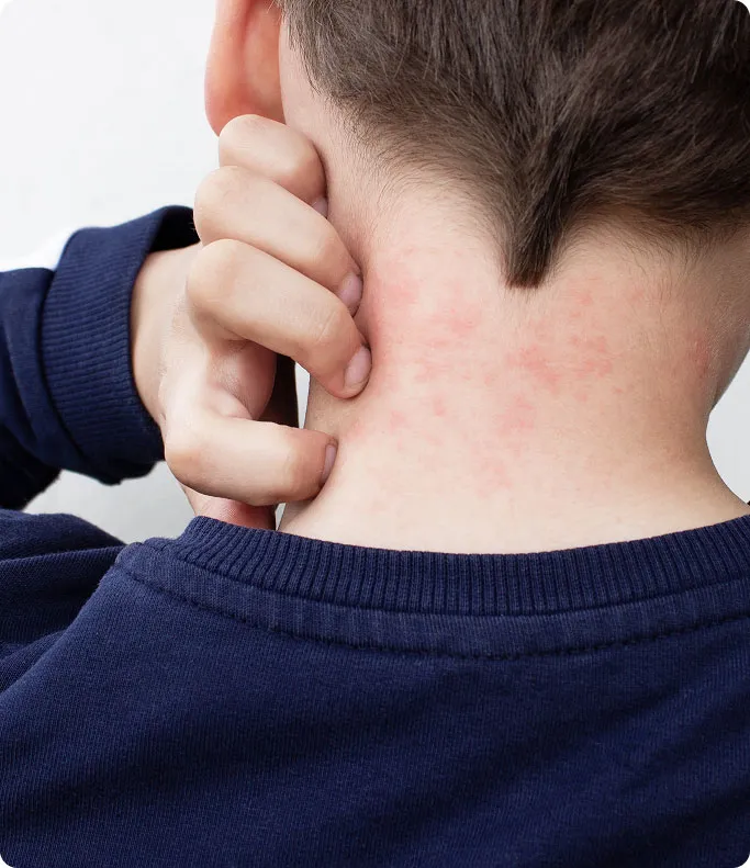 Common Symptoms of Hives to Look Out For