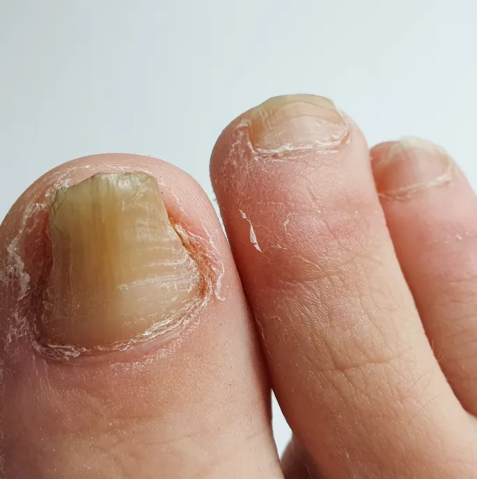 Common Symptoms of Nail Conditions to Look Out For