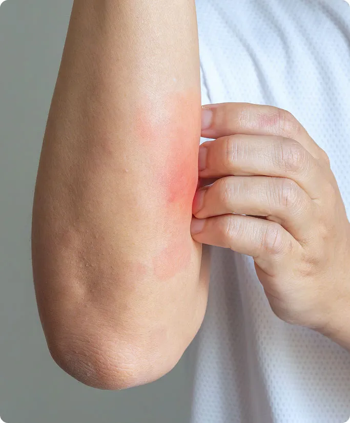 Common Symptoms of Psoriasis to Look Out For