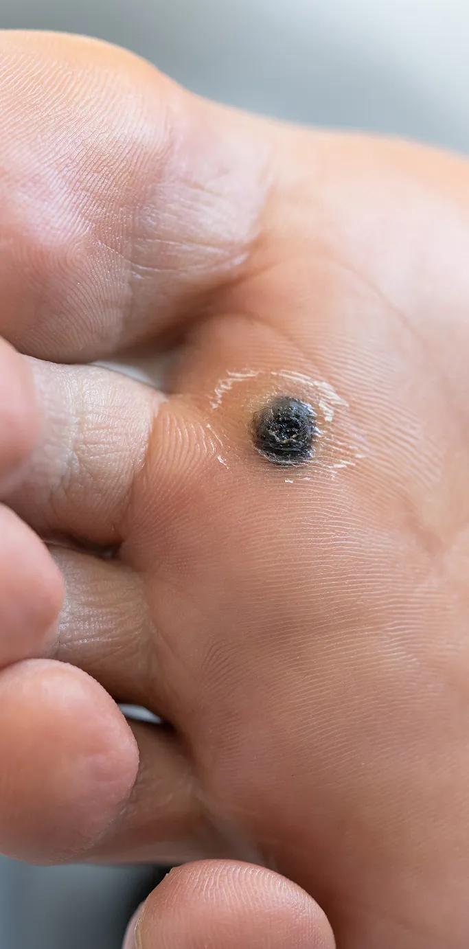Common Symptoms of Warts to Look Out For
