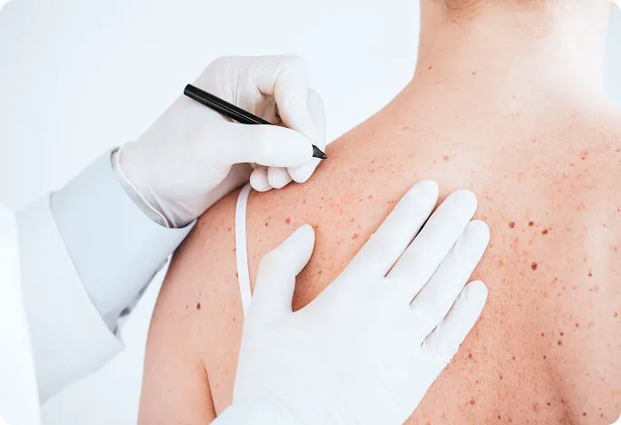 Common Types of Skin Cancer Surgery