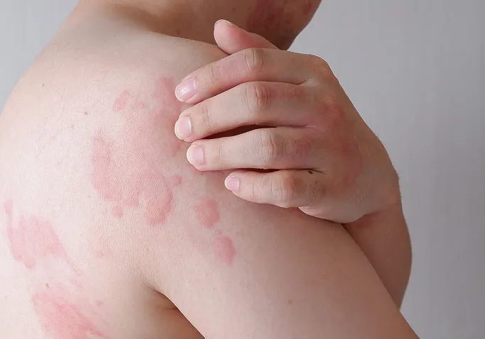 What Are Hives?
