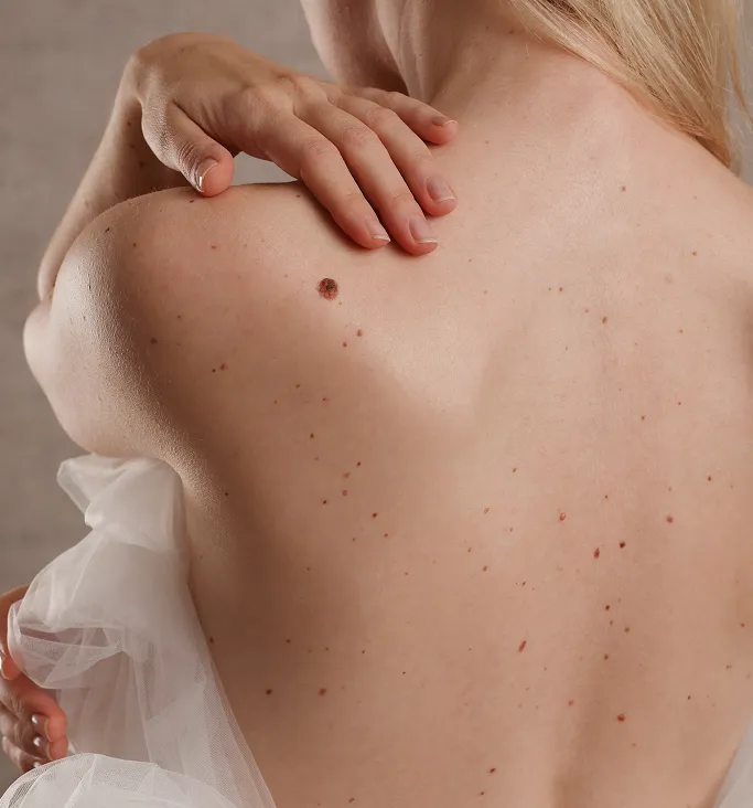 What Is Benign Skin Growth?