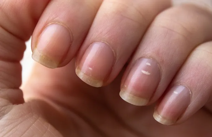 What Is a Nail Condition?
