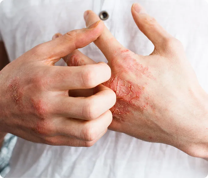 What Is Psoriasis?