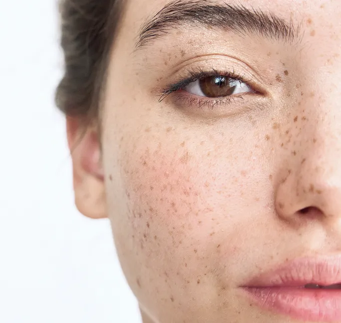 What Is Skin Pigmentation?