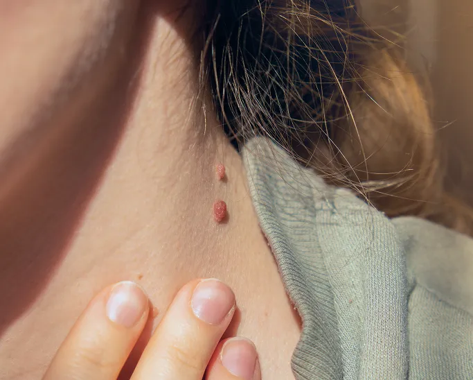 What Is a Viral Wart?